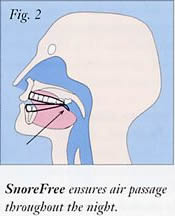Figure 2 -  Snorefree ensures air passage throughout the night