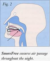 Snore Free 2 Figure 2